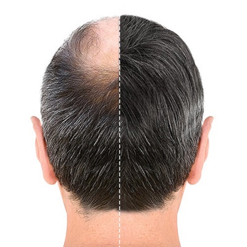 Non Surgical Hair Replacement