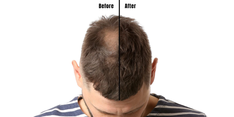 Non-Surgical Hair Replacement Service in Kolkata